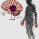 パーキンソン病を表すイラスト