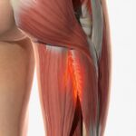 大腿二頭筋が負傷しているイラスト