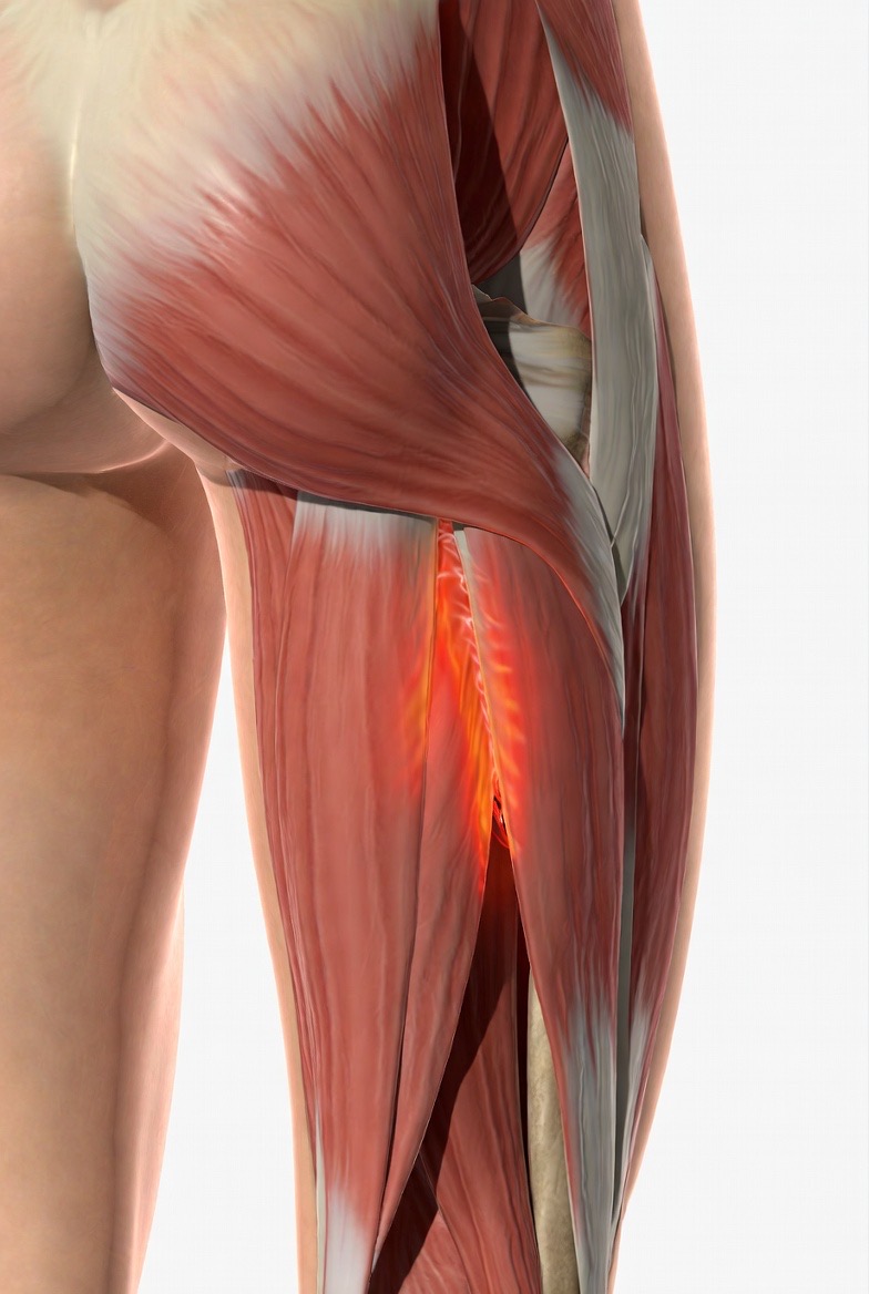 大腿二頭筋が負傷しているイラスト